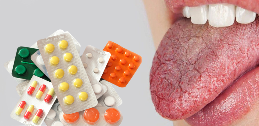 چه داروهایی باعث خشکی دهان می شوند؟